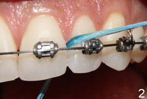 flossing-with-braces